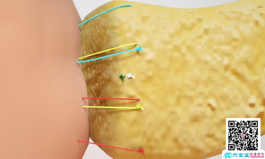 三维3d动画演示胰十二指肠切除术6.jpg