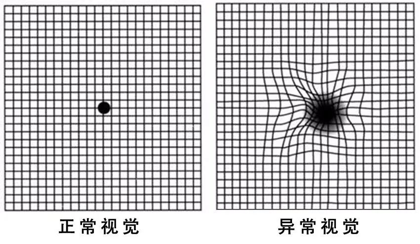 糖尿病患者出现这个症状，可能是失明前兆