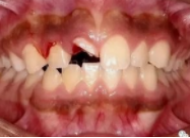 儿童换牙常见3大问题，保护牙齿需要做好这5点