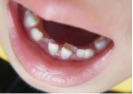 儿童换牙常见3大问题，保护牙齿需要做好这5点