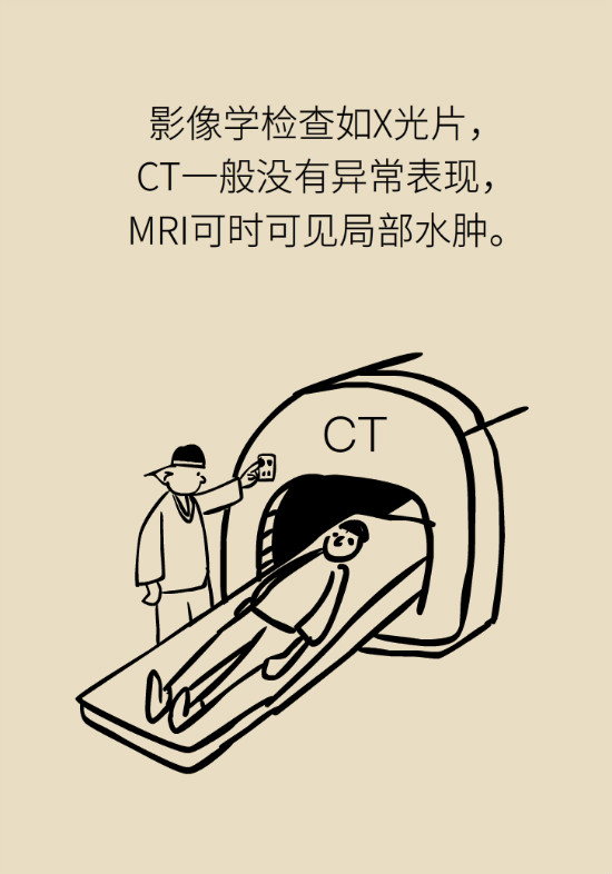 梨状肌综合征