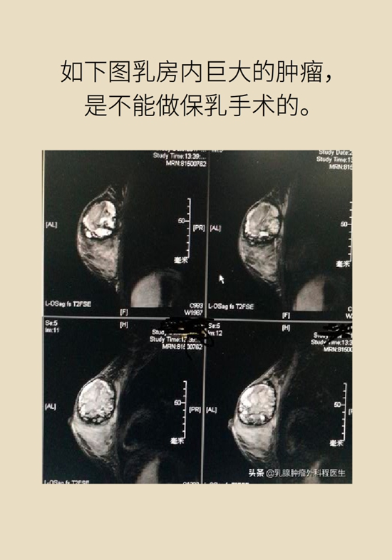 乳腺癌科普动漫