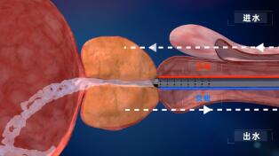  武汉三维医学医疗动画宣传片制作《经尿道前列腺切除术-手自一体控压输注泵》 医疗手术动画视频演示