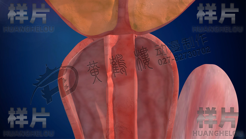 武汉前列腺膀胱手术《尿道保护鞘》三维医疗器械动画演示