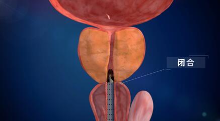 武汉医疗教学动画《前列腺膀胱癌手术尿道保护鞘》器械工作原理演示宣传片